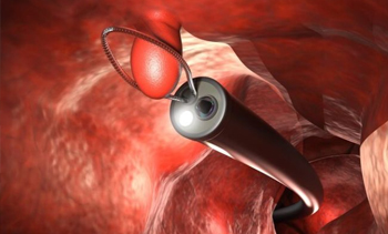 ERCP Colonoscopy