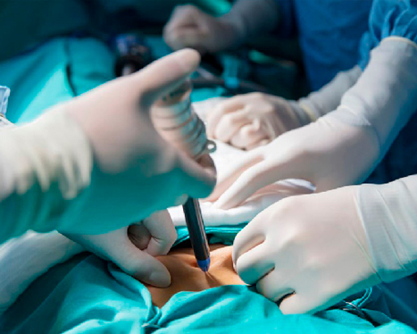 gastro surgery